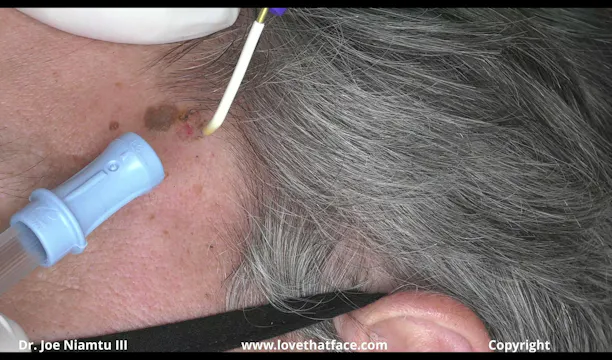 Soniquence Radiowave System Removal of Facial Keratoses