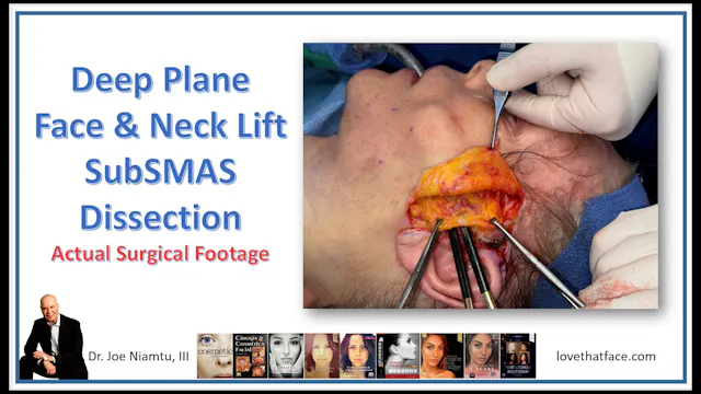 Deep Plane Dissection 3-25_1_1