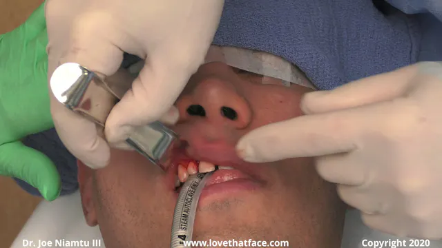 Case 1 Bilateral Placement of Submalar Cheek Implants