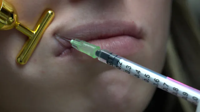 Botox Lip Flip