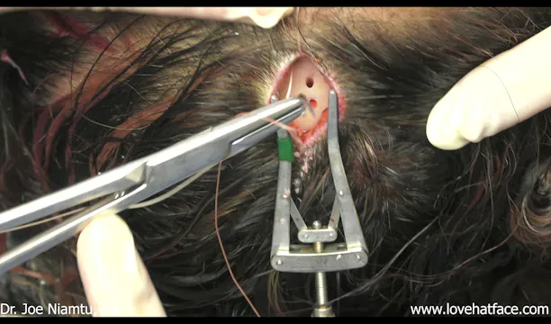 Endoscopic Brow and Forehead with Simultaneous Blepharoplasty Part 2