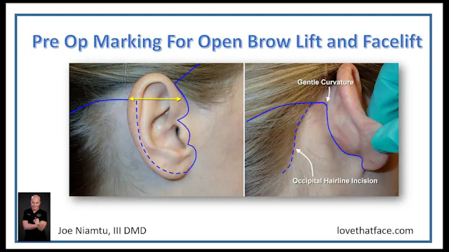 Marking the Facelift and Browlift Patient