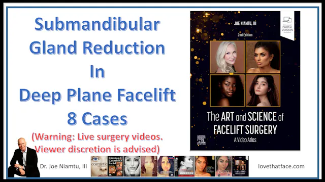 Submandibular Gland Reduction in Deep Plane Facelift : 8 Cases