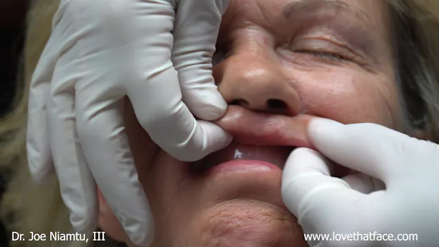 Volbella to Lip Lines, Outline and Plumping