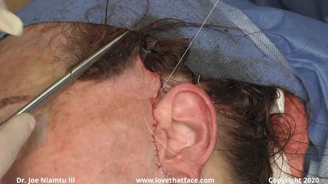 Anterior Flap Trimming