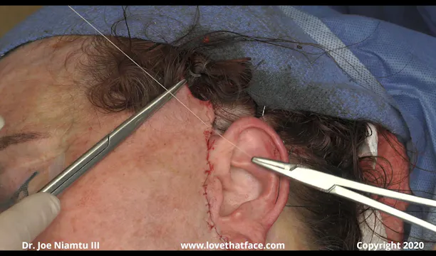 Preauricular Skin Excess Trimming