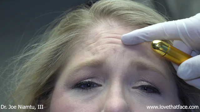 Botox to Frontalis to Glabella and Frontalis