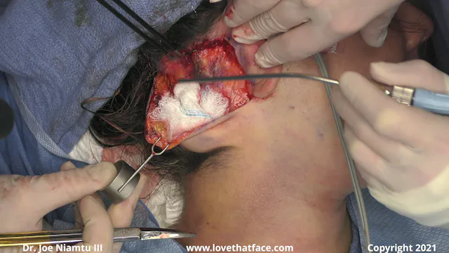 Unilateral Nonstop Facelift with Full Face CO2 Laser Resurfacing Part 1