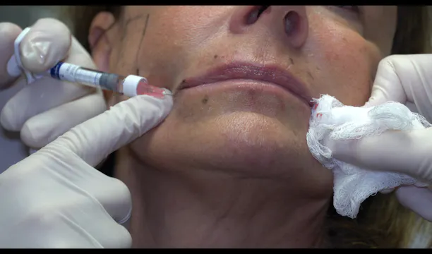 Restylane Injection to Marrionette Lines