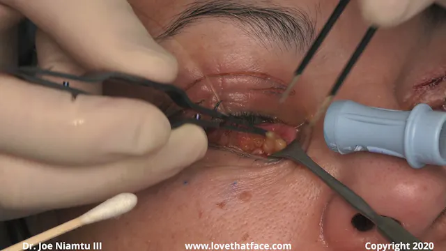 Upper and Lower Laser Blepharoplasty with Chemical Peel
