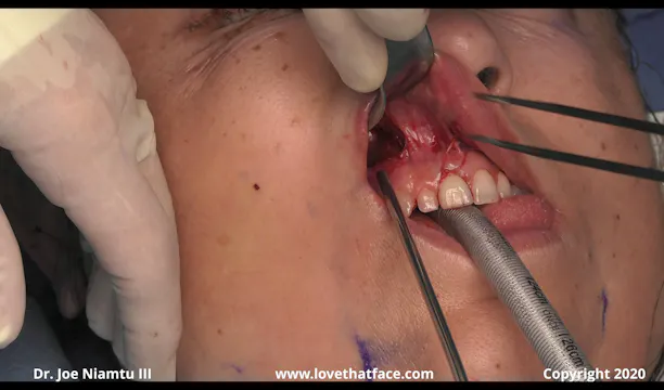 Unilateral Silicone Cheek Implant and Buccal Fat Reduction