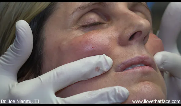 Voluma to Cheeks with Cannula and Needle and Restylane Kysse to Lips