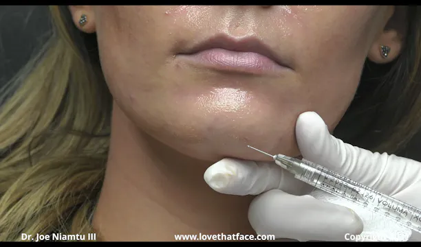 Voluma to Chin, Mentolabial Fold and Mandibular Border