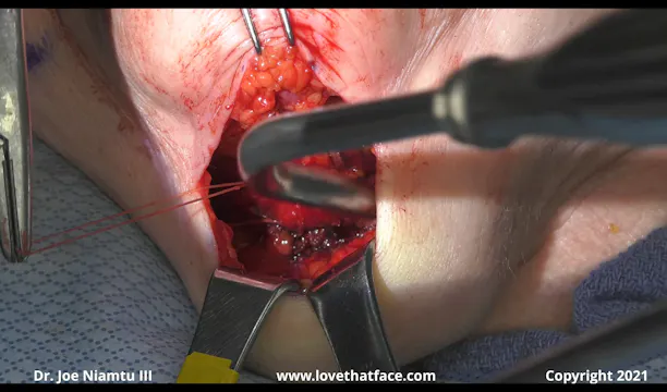 Close Up Platysmaplasty Sutures