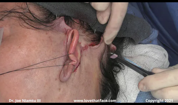 Key Sutures and Skin Flap Trimming