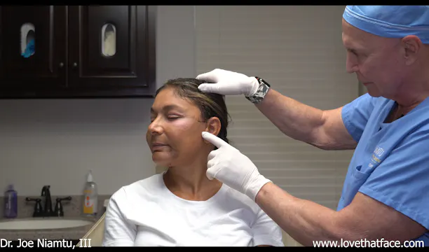 8 Days after Facelift Follow Up