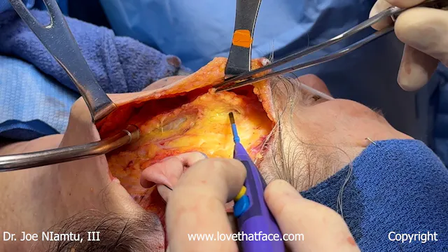 19. Radiowave SubSMAS Dissection and Suturing