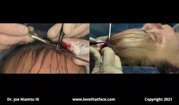 Transfollicular Brow and Forehead Lift with Upper BLepharoplasty  Case 3