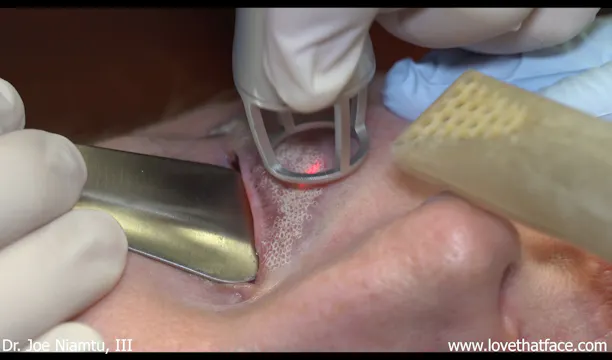 CO2 Laser Resurfacing of Lower Lids with Local Anesthesia
