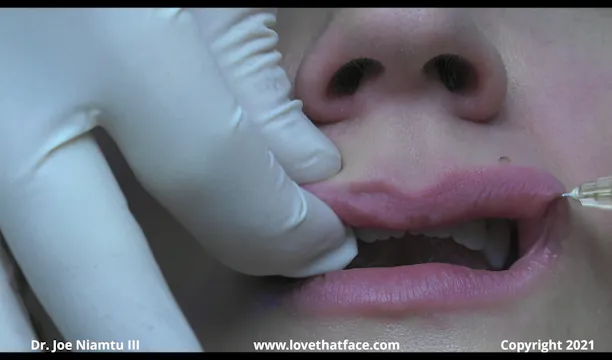 Cannula Injection to Upper Lip with Restylane