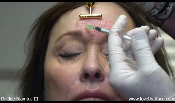 Botox over Filler in Glabella