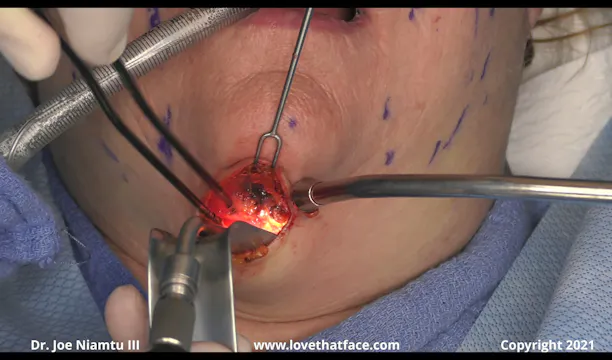 Case 1 Platysmaplasty and Comprehensive Facelift with SMASectomy