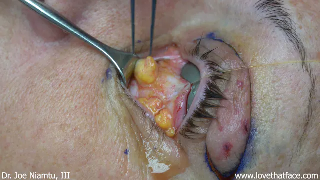 Unilateral Laser Assisted Upper and Lower Bleph with Canthopexy and Lower Lid CO2 laser