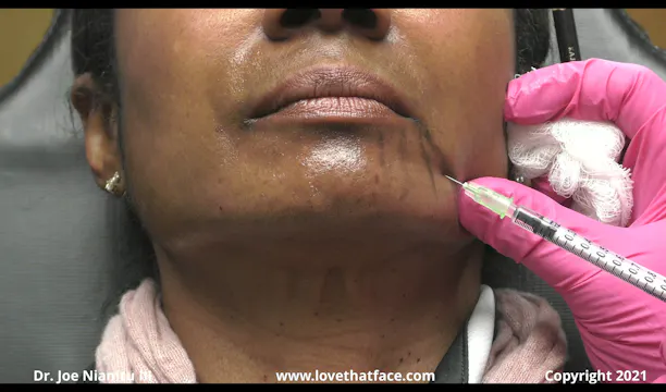 Botox to DAO, Chin, Lips Lines