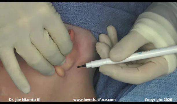 Case 2 Mustarde and Davis Otoplasty
