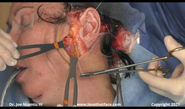 SMASectomy