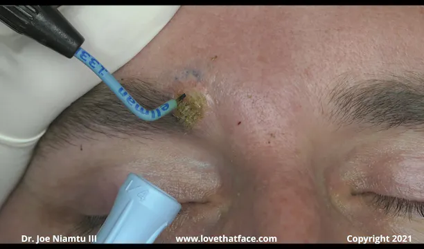 Ellman Radiowave Ablation of Eyebrow Nevi