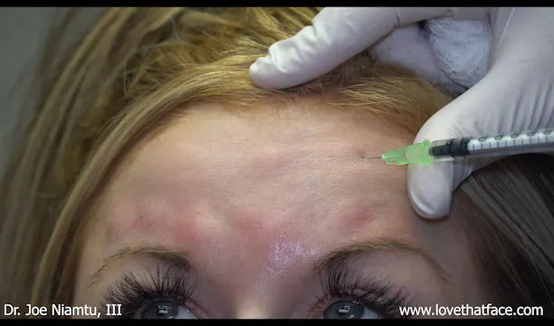 Botox to Glabella and Frontalis in Young Patient 1D