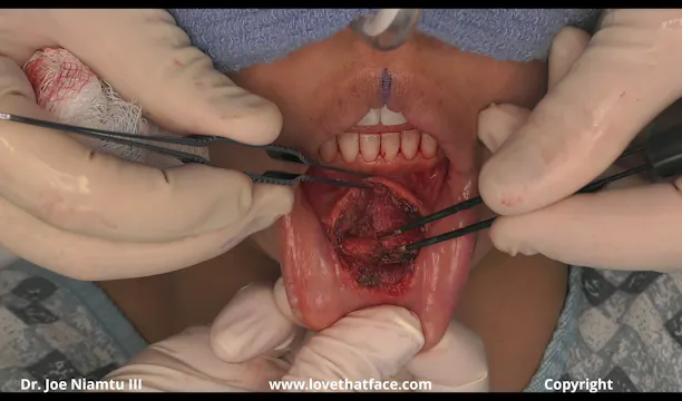 Intraoral Placement of Small FMG Silicone Chin Implant