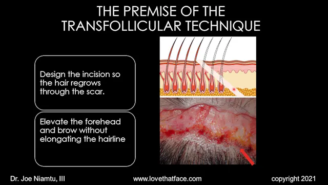 Opus Platinum Brow and Forehead Lift Lecture