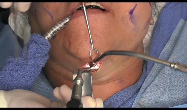 Case 3 Revision Facelift Part 1