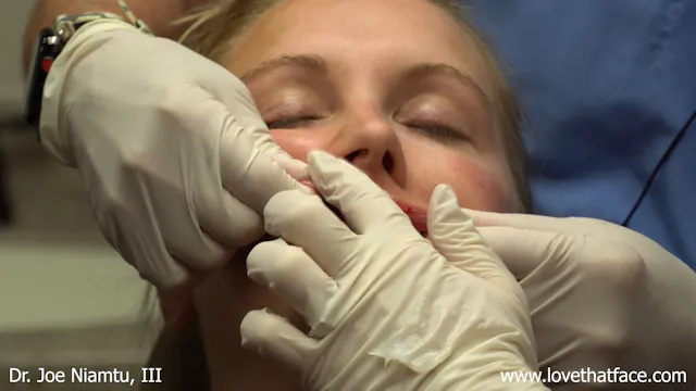 Restylane Kysse to Lips with Needle