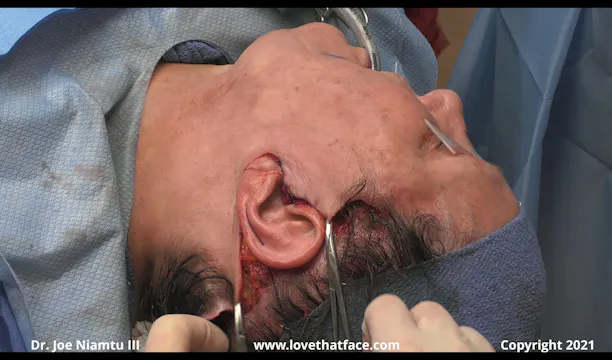 Facelift Skin Tension Vectors Posteriorly and Superiorly
