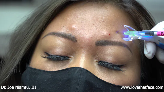 Botox 25 units to glabella and frontalis regions