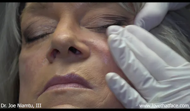 Two Methods of Cheek Filler Injection