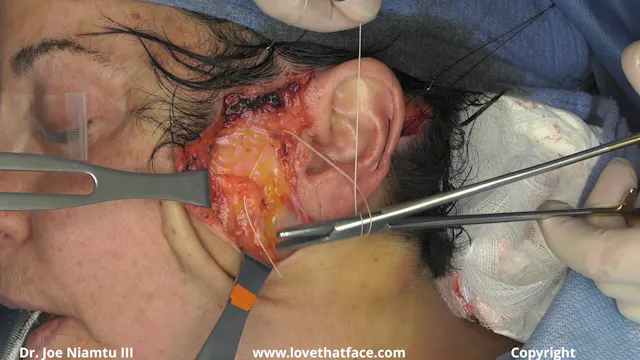 Deep Plane SMASectomy