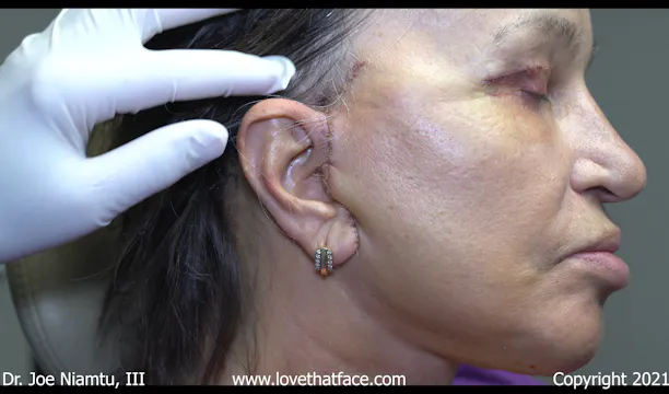 Revision Facelift part 3