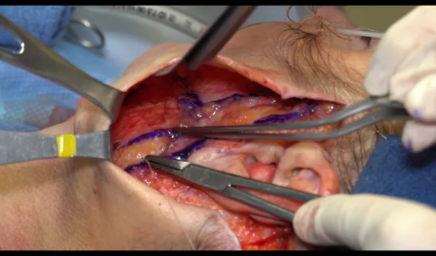 C SMASectomy