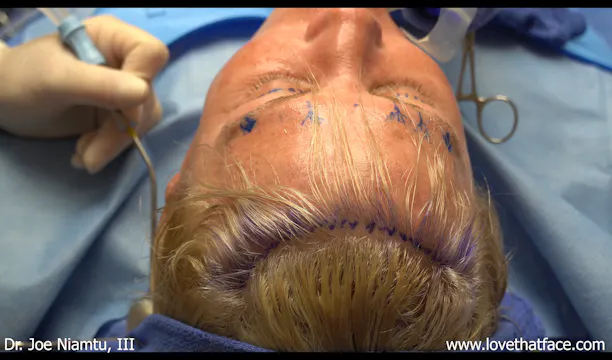 Transfollicular Brow and Forehead Lift with Blepharoplasty Case 1