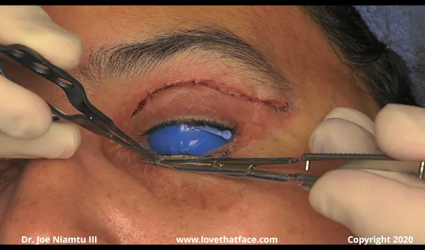 Upper Revision Bleph with Fine Wire and Lower Lid Skin Pinch