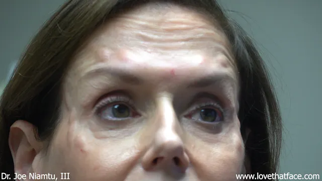 Vein Scan and Dysport to Lateral Canthus and Glabella