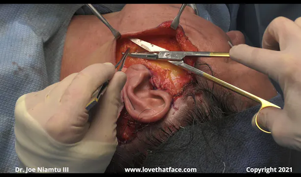 Identifying and Treating the Jowl