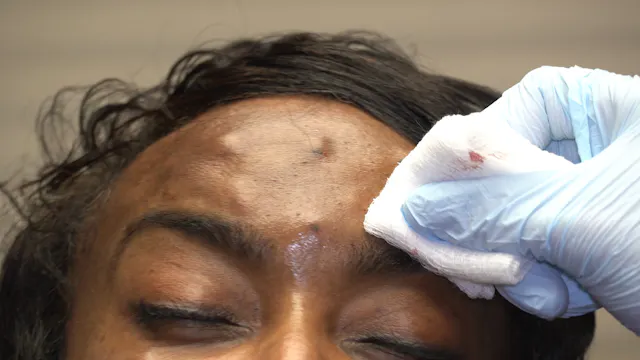 Botox to Glabella, Frontalis and DAO