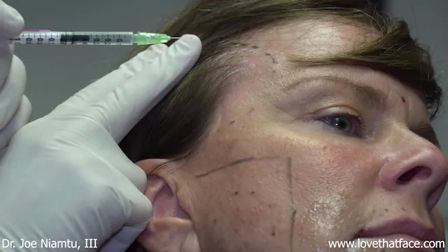 Botox to bilateral Masseter and Temporalis