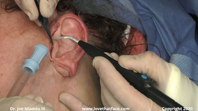 Great anterior trim