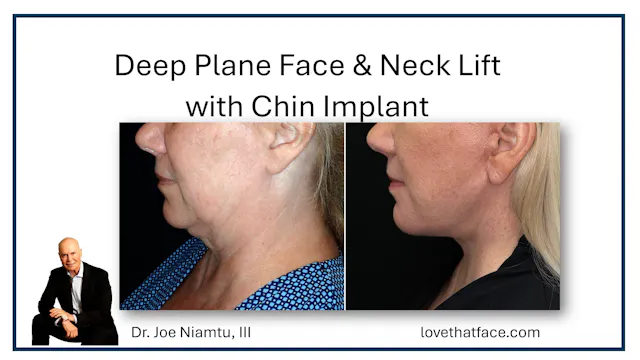 Deep Plane Facelift with Chin Implant Great Case